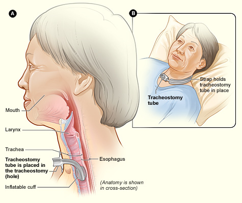 Read more about the article What Is a Trach?